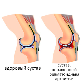 Ревматоидный артрит