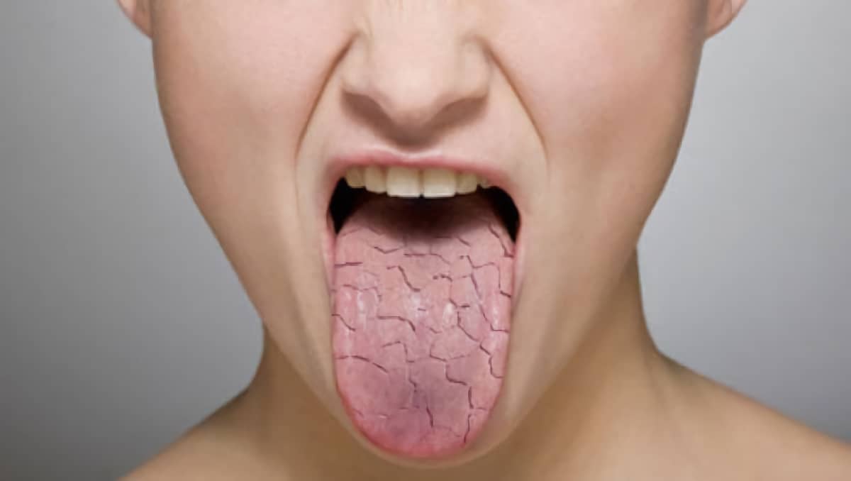 Сухость во рту