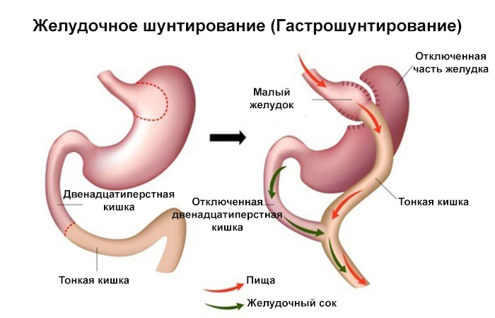 Шунтирование желудка