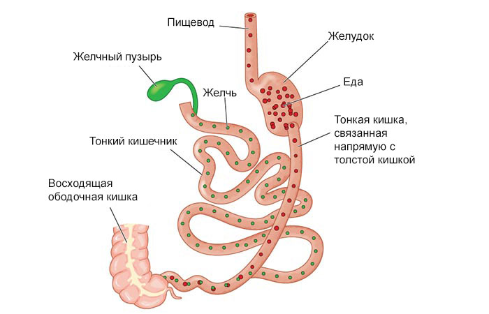 Выключение двенадцатиперстной кишки